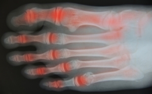 Stretches May Help Arthritic Feet