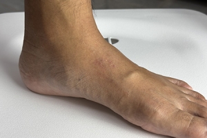 Reasons for a Lump on Top of the Foot