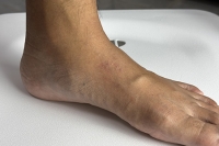 Reasons for a Lump on Top of the Foot