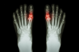 Understanding Gout and How Podiatrists Treat It