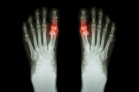 Understanding Gout and How Podiatrists Treat It