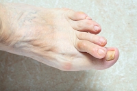 Types of Hammertoe Surgery