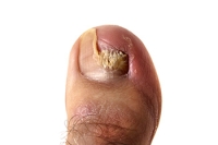 Understanding and Treating Toenail Fungus