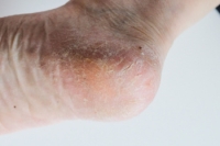 Causes of Cracked Heels