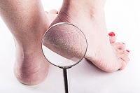 Reasons for Cracked Heels